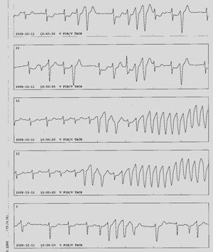 急性心肌缺血导致短阵室速发作（图为监护导联连续记录）